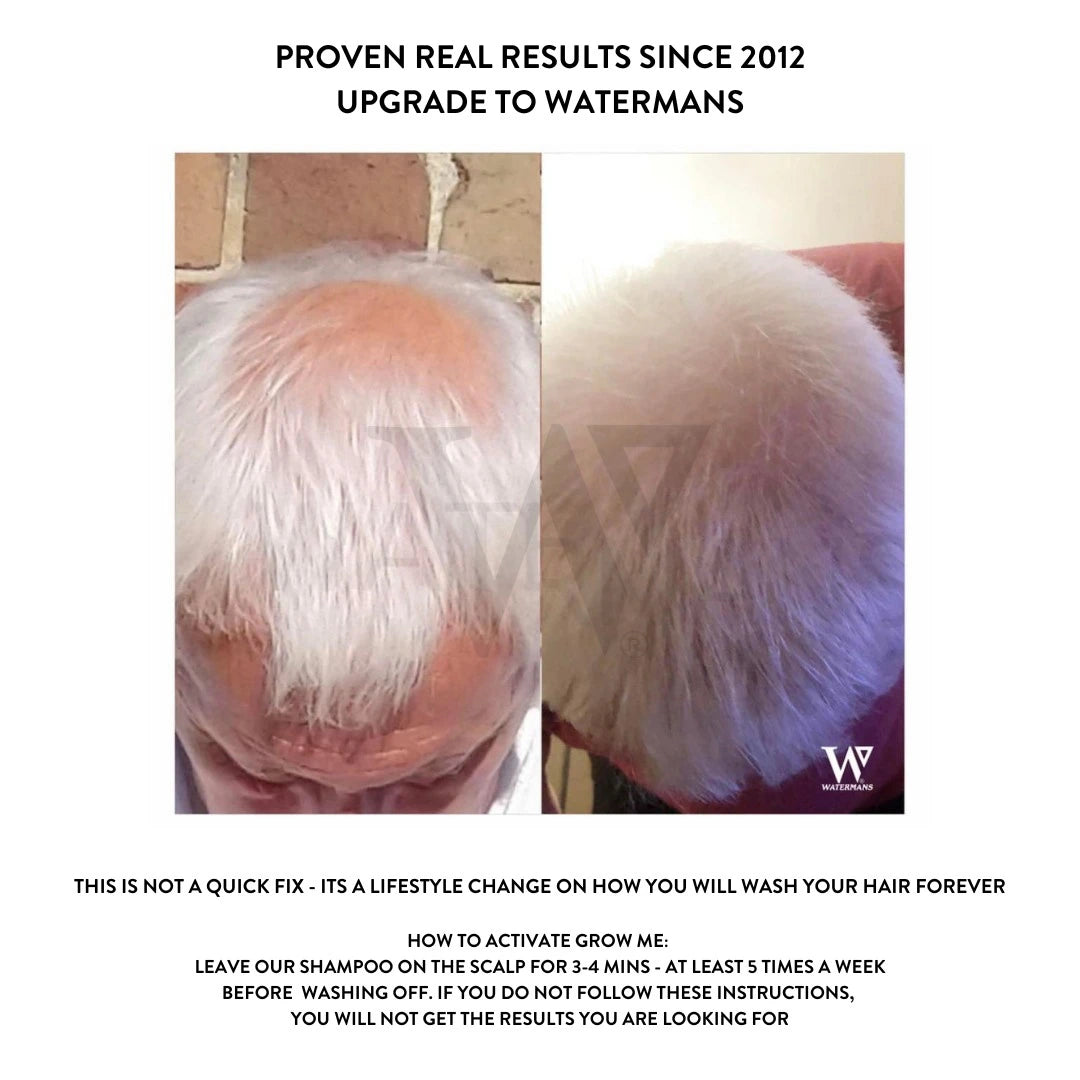 Grow More Scalp Elixir + Hair density Treatment, Hair Loss Serum