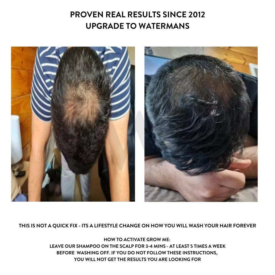 Grow More Scalp Elixir + Hair density Treatment, Hair Loss Serum