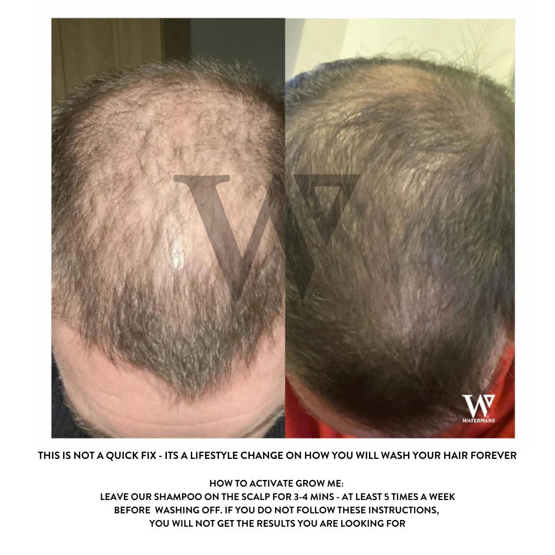 Grow More Scalp Elixir + Hair density Treatment, Hair Loss Serum