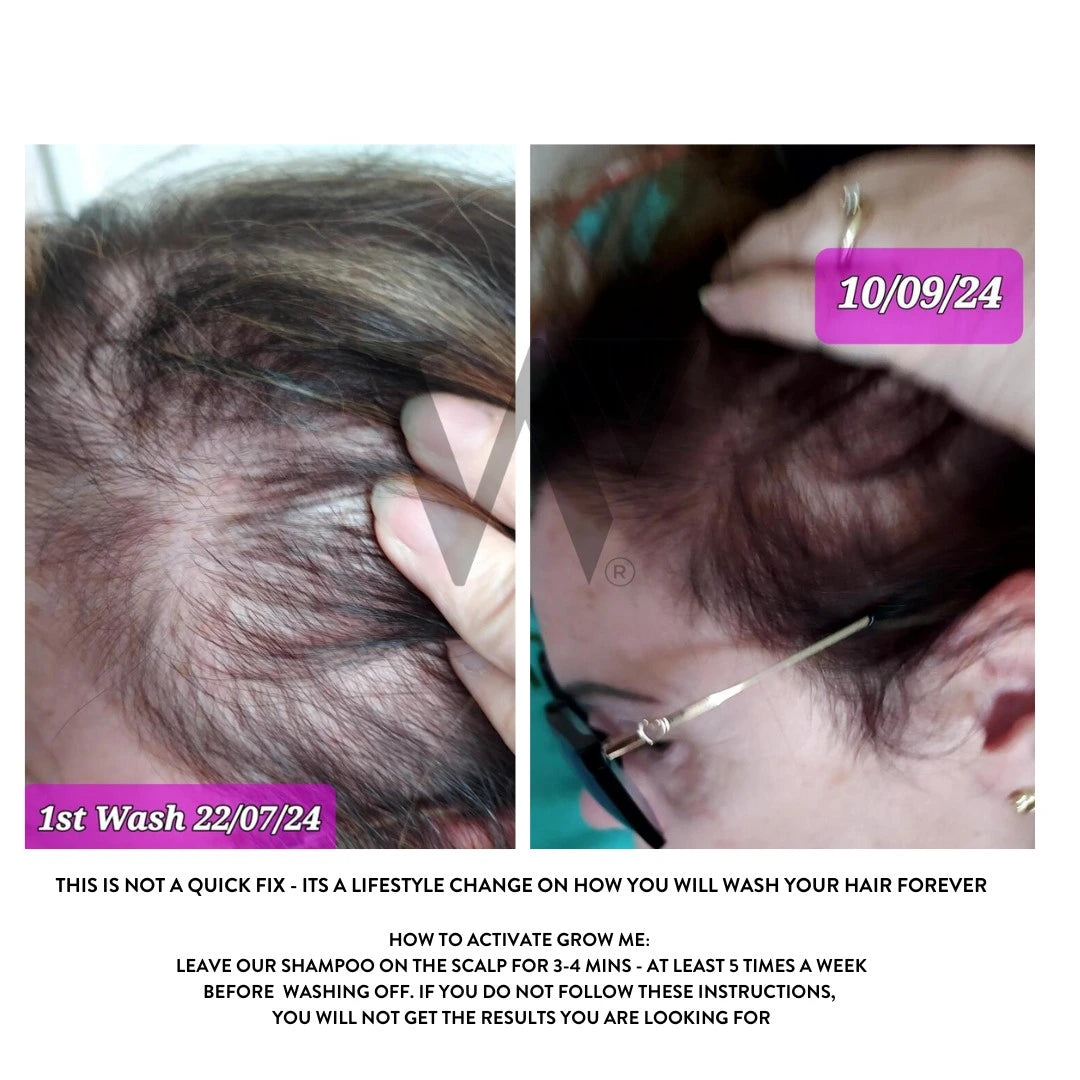 Grow More Scalp Elixir + Hair density Treatment, Hair Loss Serum