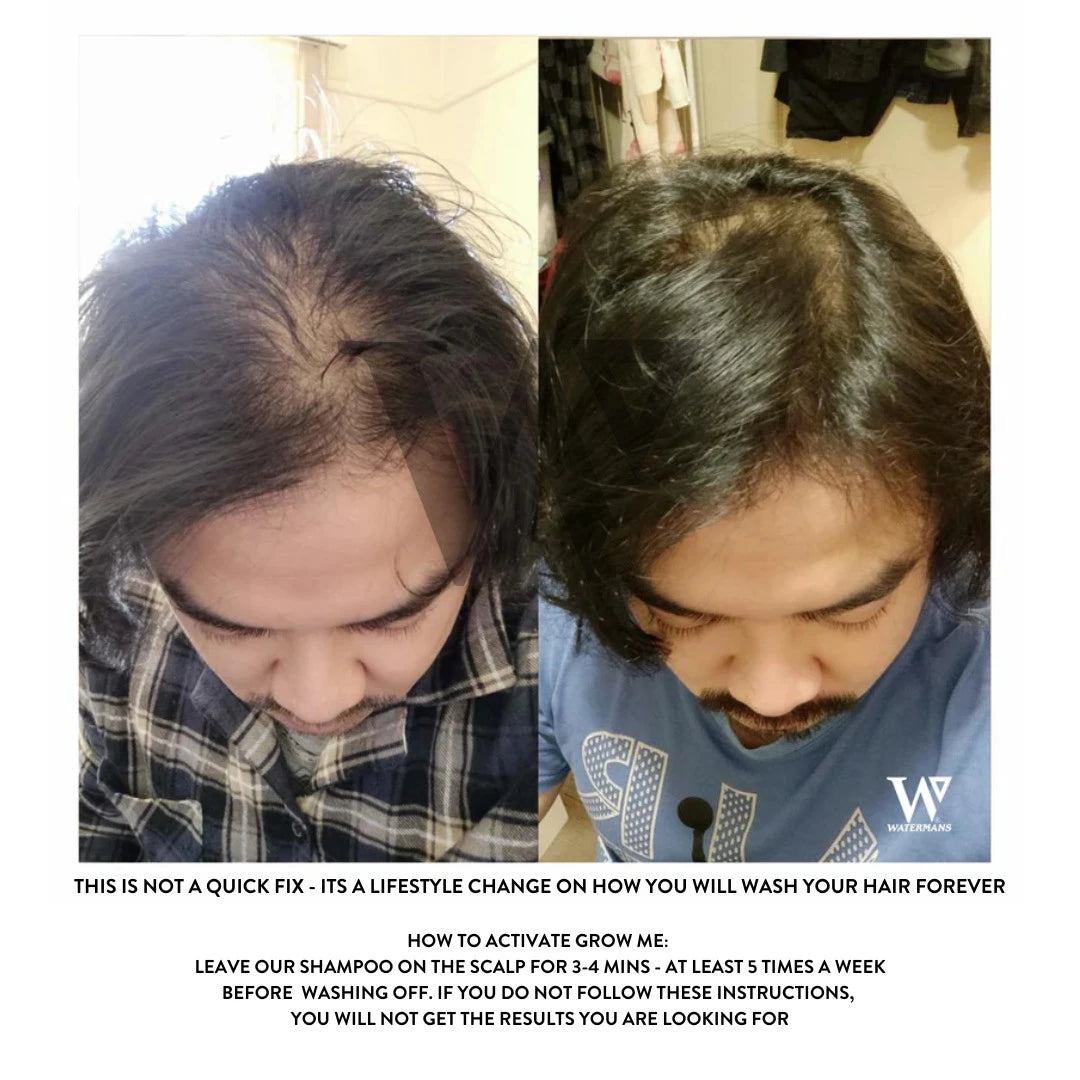 Grow More Scalp Elixir + Hair density Treatment, Hair Loss Serum