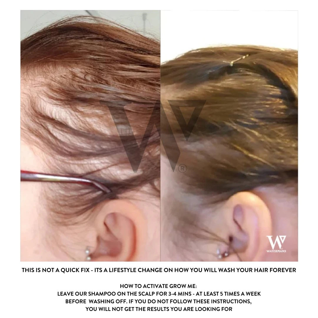 Grow More Scalp Elixir + Hair density Treatment, Hair Loss Serum