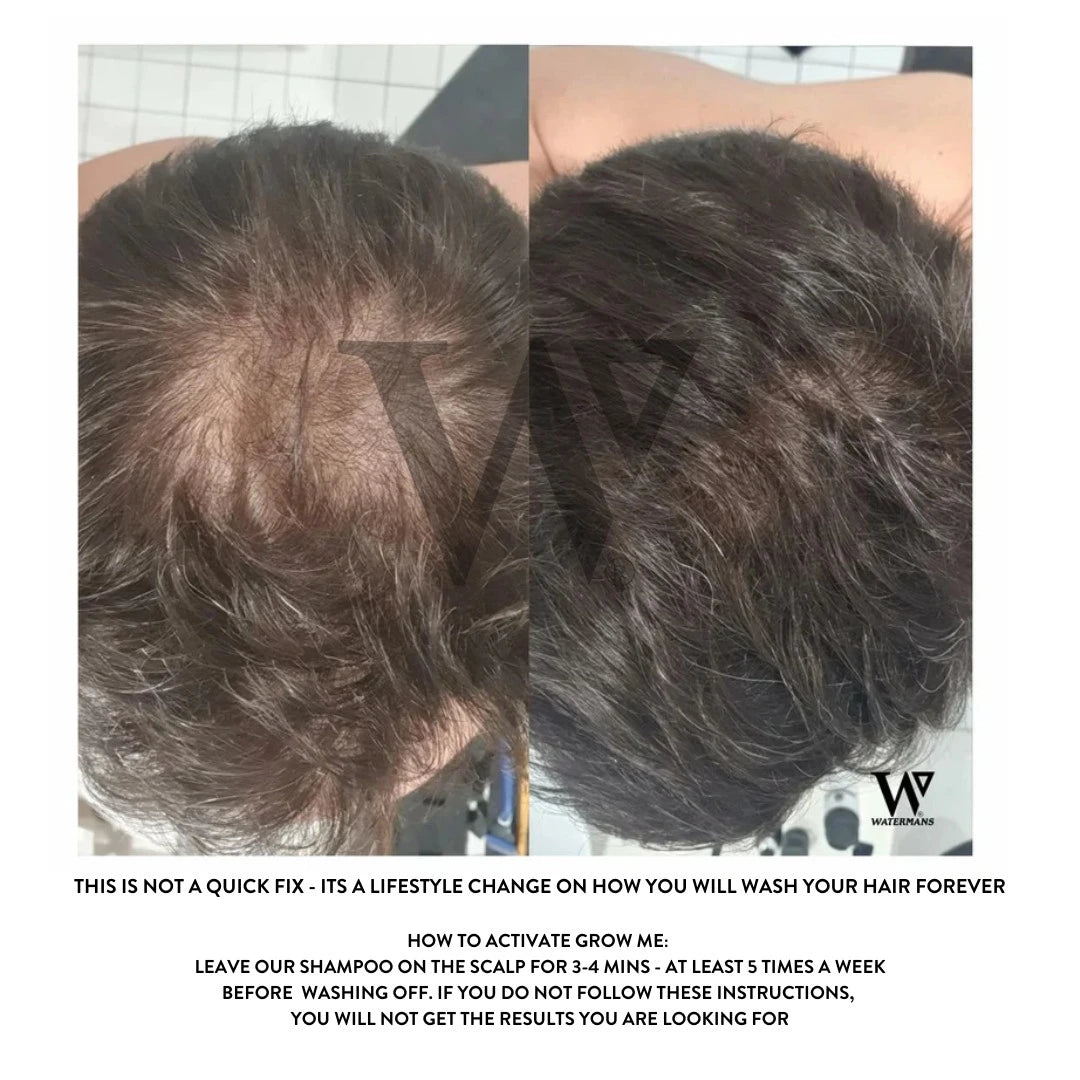 Grow More Scalp Elixir + Hair density Treatment, Hair Loss Serum